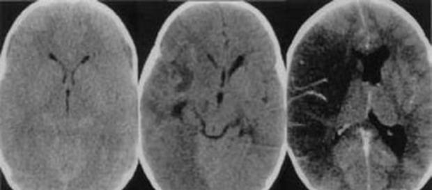 meningoencefalite amebica