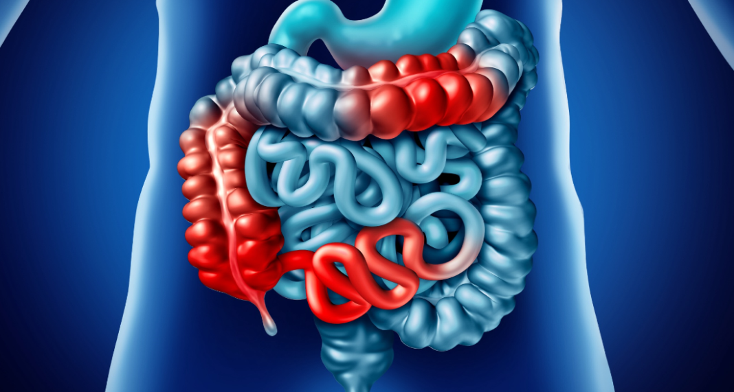 Morbo di Crohn, tra i sintomi c'è il dolore addominale